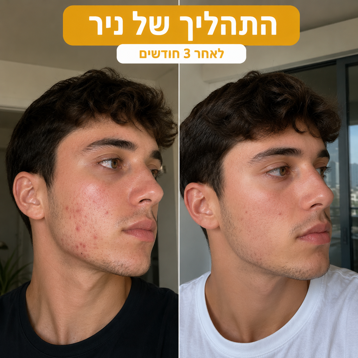 מארז לטיפול באקנה